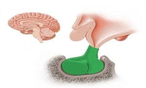 تومور هیپوفیز
