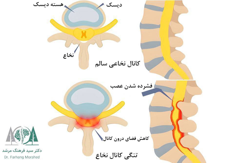 سیاتیک ناشی از تنگی کانال نخاعی 