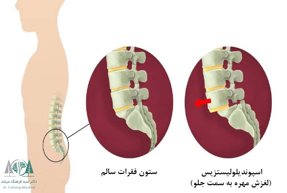 سیاتیک ناشی از اسپوندیلولیستزیس یا لغزش مهره