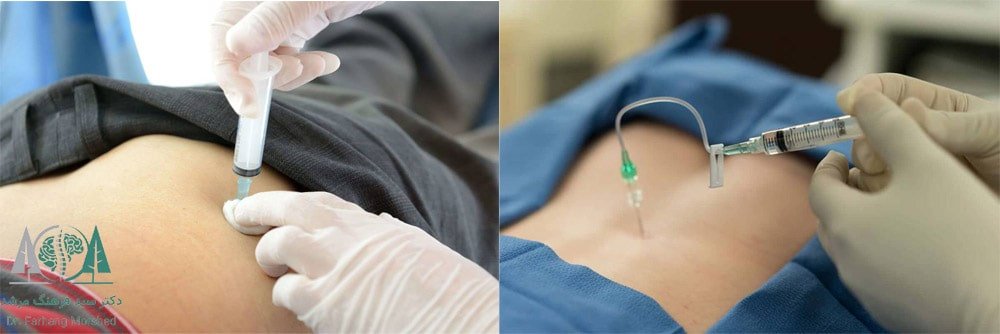 درمان‌های تزریقی سیاتیک