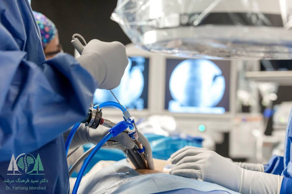 درمان سیاتیک با جراحی لامینکتومی