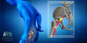 دکتر فرهنگ مرشد 19 درد عصب سیاتیک