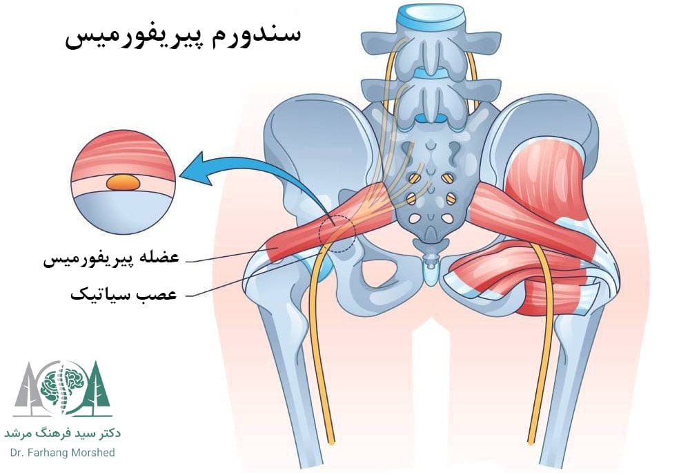 سیاتیک ناشی از سندروم پیریفورمیس