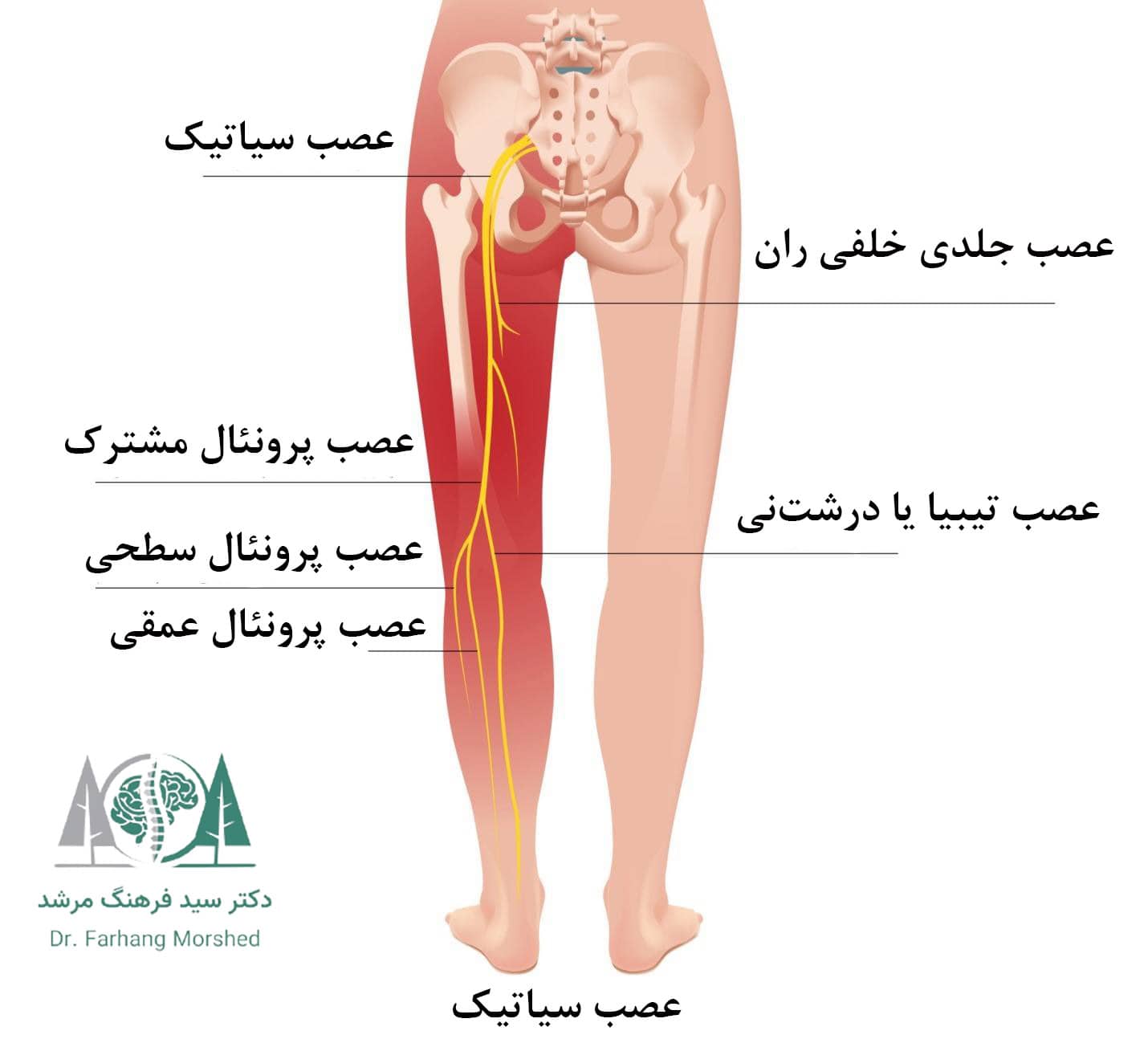 سیاتیک چیست؟