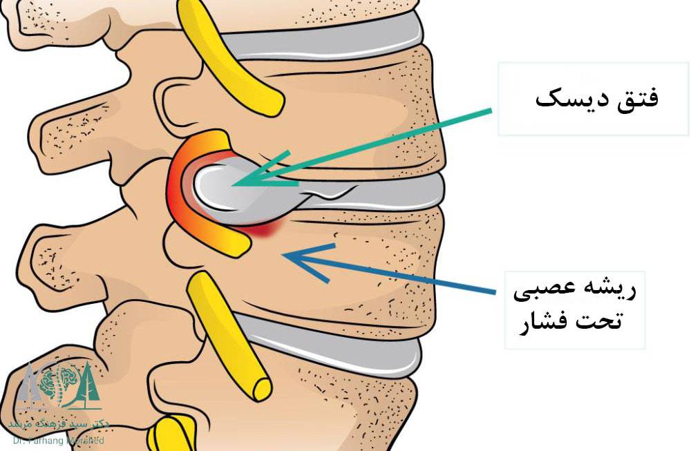 سیاتیک ناشی از فتق یا بیرون‌زدگی دیسک کمر