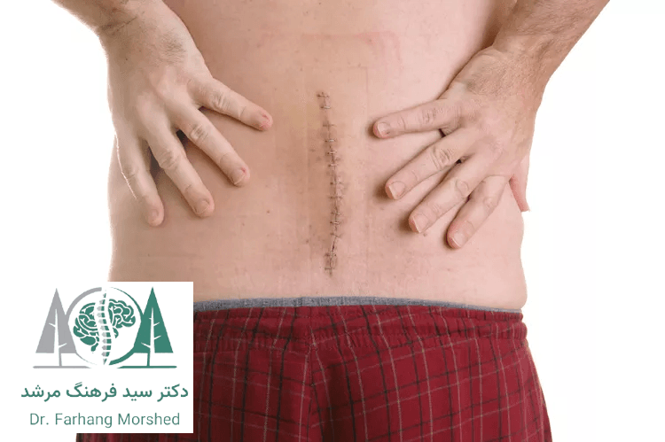 جراحی تنگی کانال نخاعی | پایان درد و تجربه واقعی بیماران 13 Recovery after spinal surgery