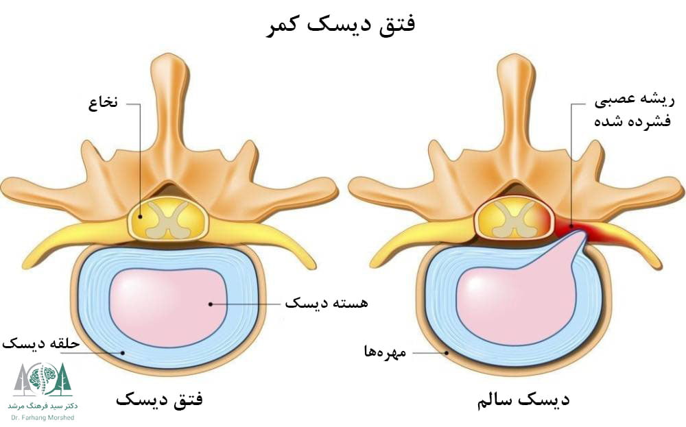 درمان افتادگی پا در دیسک کمر