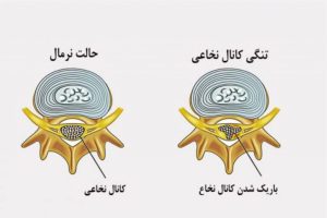 بهترین دارو برای تنگی کانال نخاعی | لیست قرص و پماد 1 بهترین دارو برای تنگی کانال نخاعی