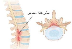 بهترین دارو برای تنگی کانال نخاعی | لیست قرص و پماد 5 بهترین دارو برای تنگی کانال نخاعی