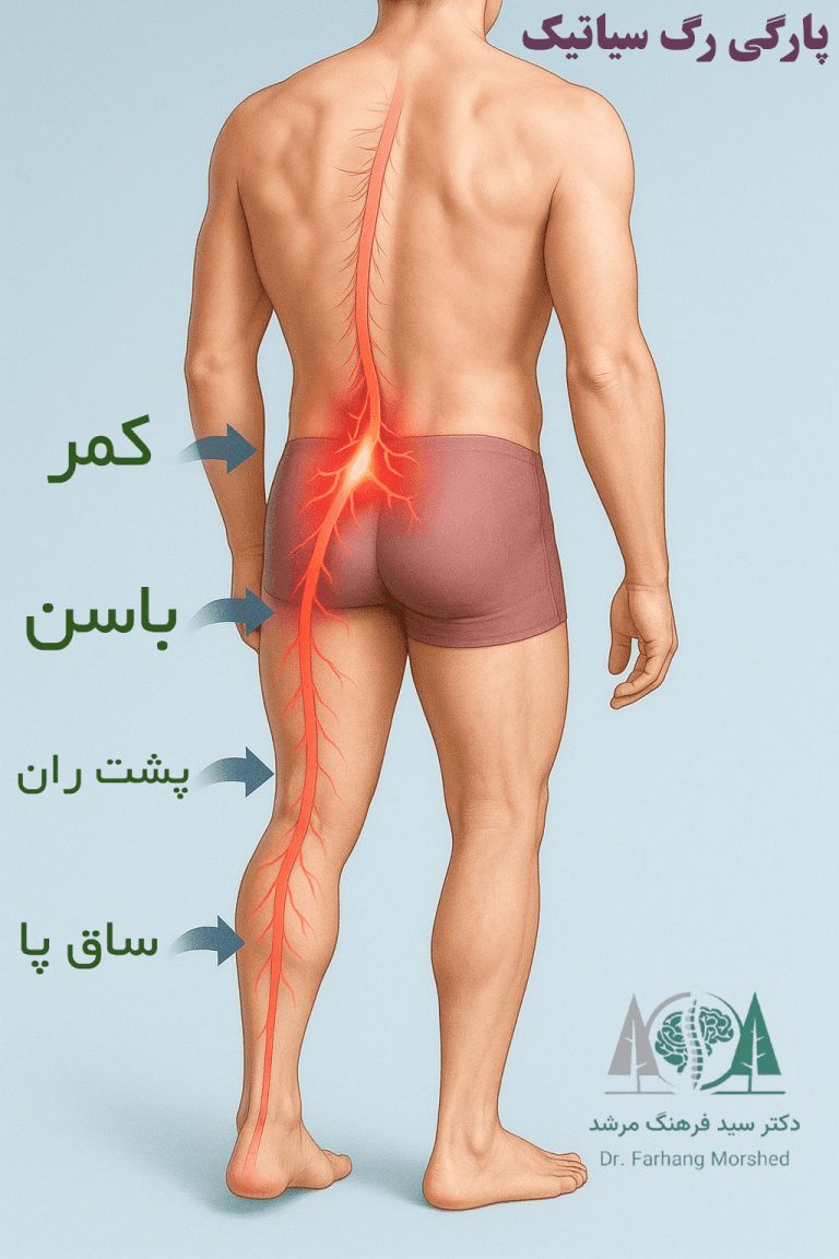 علائم پارگی رگ سیاتیک