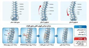 جراحی اسکولیوز
